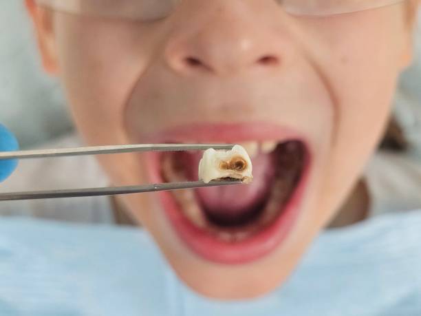 Best Emergency Dental Extractions in Copperton, UT