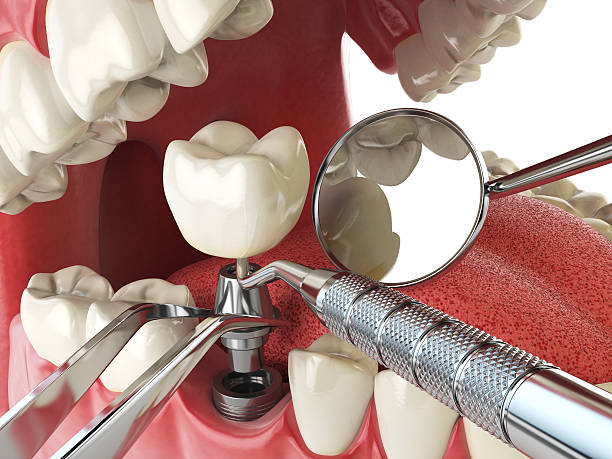 Best Emergency Root Canal Treatment in Copperton, UT